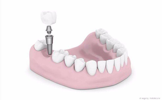 Implantat zum Ersatz eines fehlenden Zahnes Implantat zum Ersatz eines fehlenden Zahnes