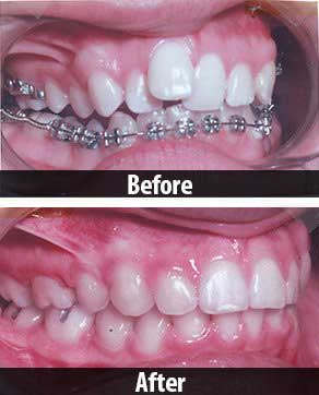 Dental — Before And After Braces In North Hills, CA Dental — Before And After Braces In North Hills, CA