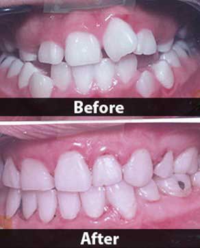 Family Dentist — Before And After Dental Care In North Hills, CA Family Dentist — Before And After Dental Care In North Hills, CA