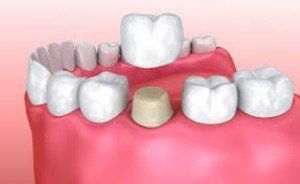 Dental Crowns—Restorative Dentistry in Lake Wylie, SC Dental Crowns—Restorative Dentistry in Lake Wylie, SC