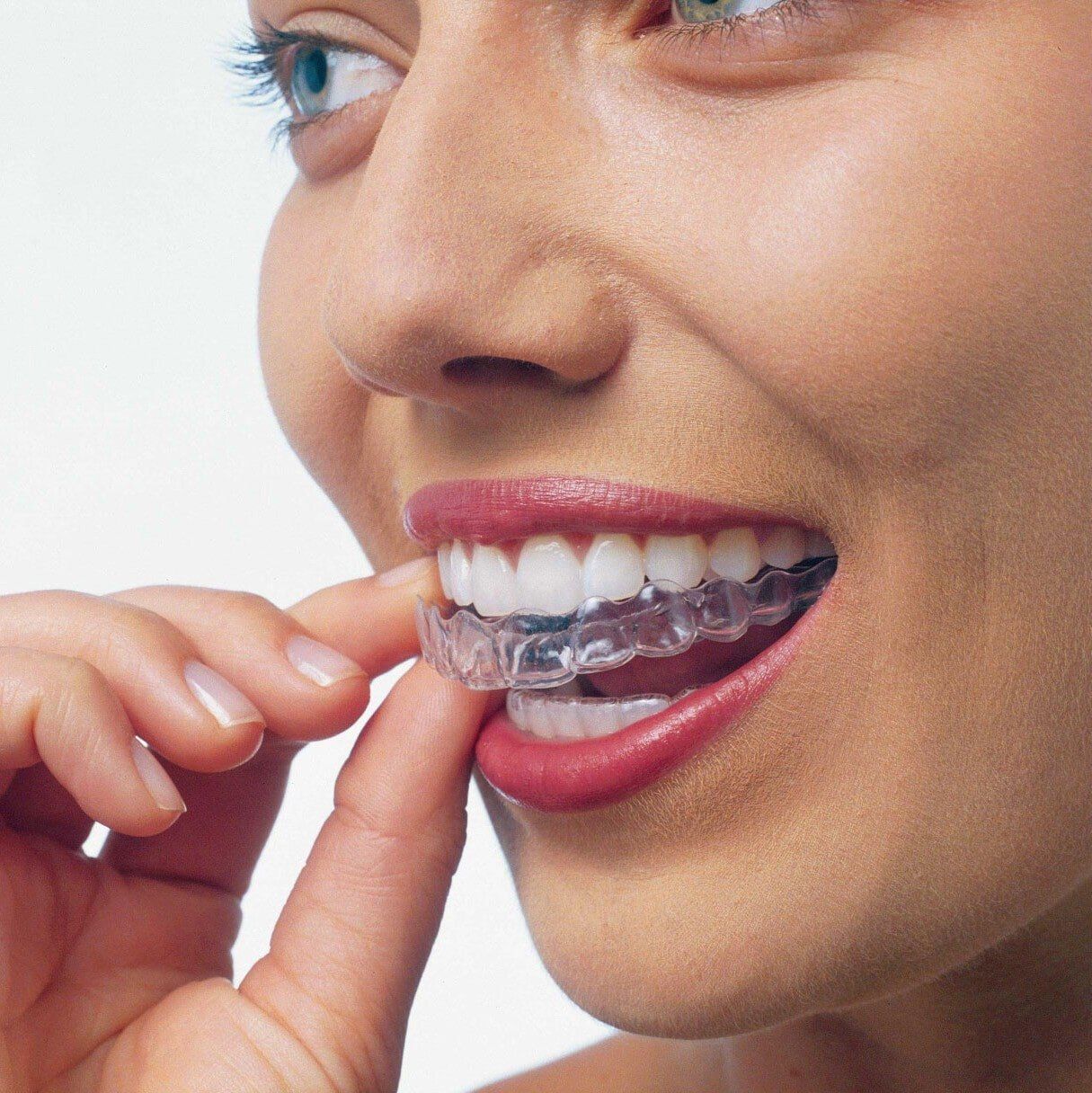 A Person Wearing Invisalign—Invisalign in Lake Wylie, SC A Person Wearing Invisalign—Invisalign in Lake Wylie, SC