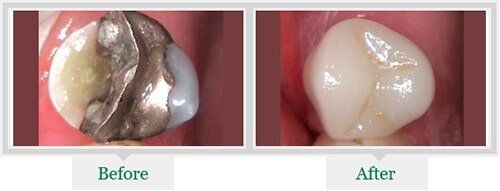 Tooth With Cavity And Tooth With Out — Dentist in Lake Wylie, SC