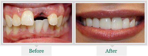 Tooth Decay And White Teeth — Dentist in Lake Wylie, SC Tooth Decay And White Teeth — Dentist in Lake Wylie, SC