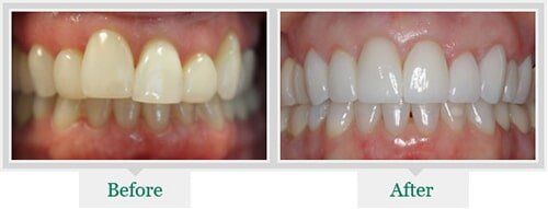 Yellowish Teeth And White Teeth —Dentist in Lake Wylie, SC Yellowish Teeth And White Teeth —Dentist in Lake Wylie, SC