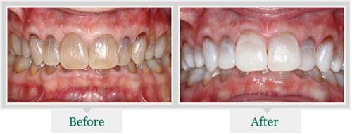 Before And After Cleaning The Teeth — Dentist in Lake Wylie, SC Before And After Cleaning The Teeth — Dentist in Lake Wylie, SC