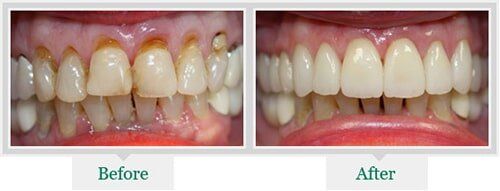 Teeth With Cavity And Clean Teeth — Dentist in Lake Wylie, SC Teeth With Cavity And Clean Teeth — Dentist in Lake Wylie, SC