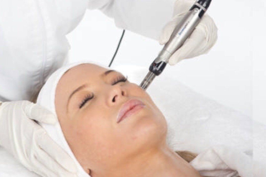 Active acne therapy