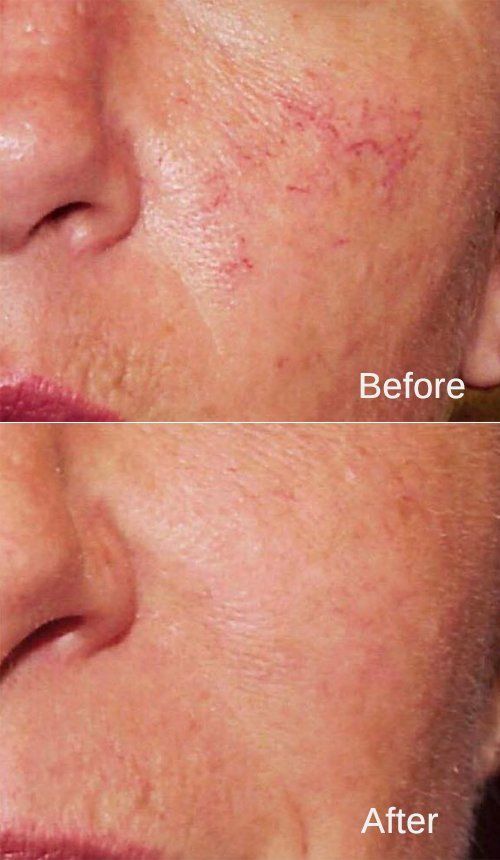 Thread vein removal treatment