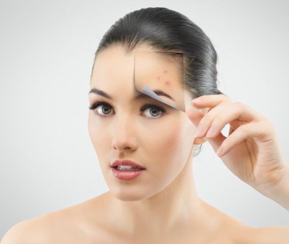 Active acne therapy