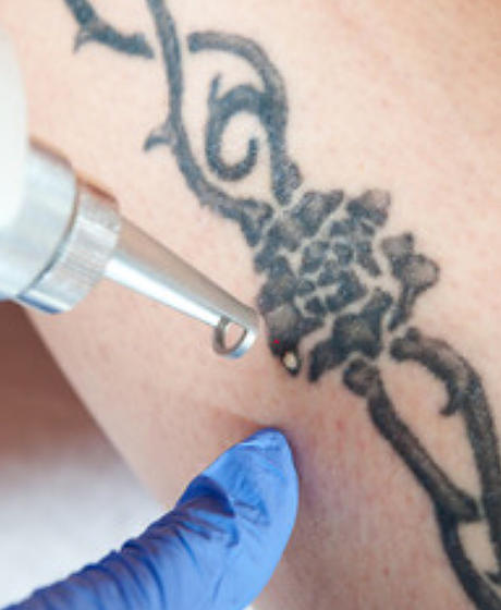 Laser tattoo removal