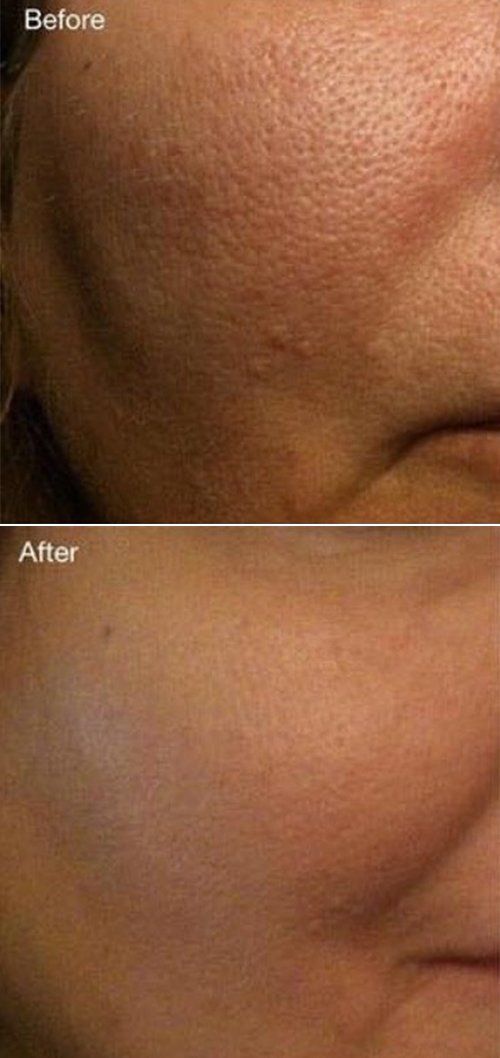 laser carbon skin treatment