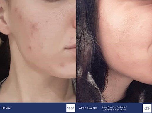 OBAGI CLENZIDERM Before and After pictures