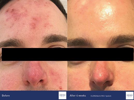 OBAGI CLENZIDERM Before and After pictures
