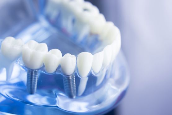 A dental model shows artificial teeth attached to metal posts, representing dental implants.