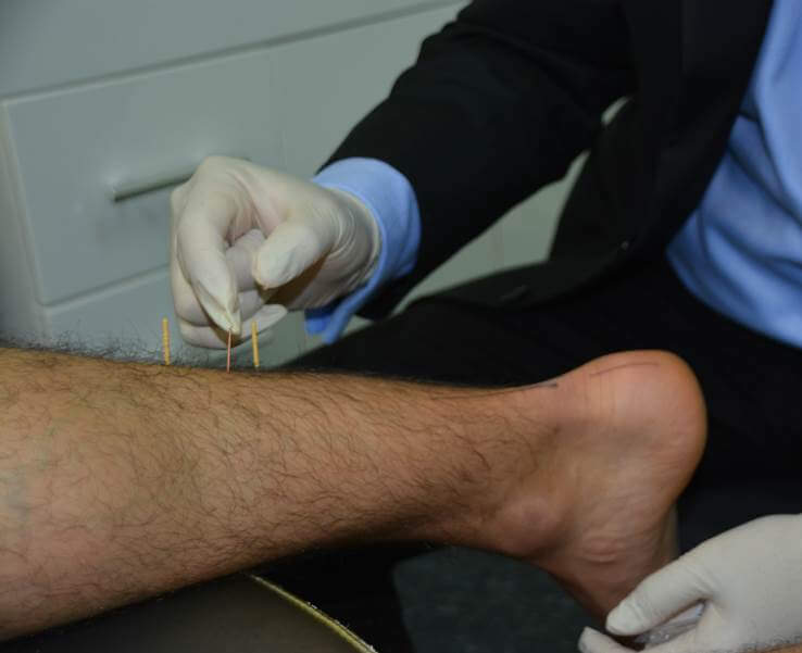 Dry Needle In leg - Perth, WA - Centrepod Podiatry