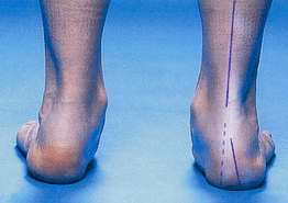 Flat Foot - Perth, WA - Centrepod Podiatry