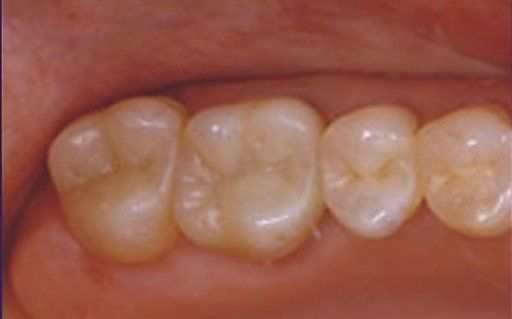 after amalgam removal