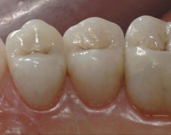 after amalgam removal