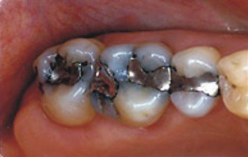 before amalgam removal