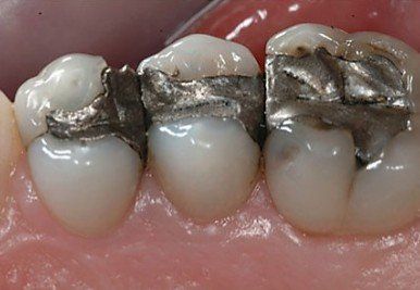 before amalgam removal