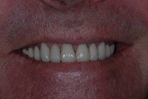 after amalgam removal