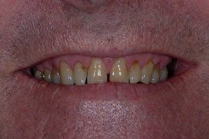before amalgam removal