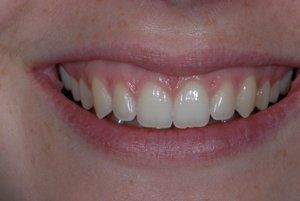 smile before invisalign