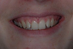 smile after invisalign