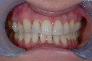 after braces