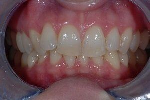 before braces