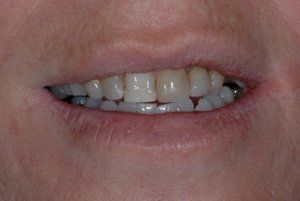 before amalgam removal
