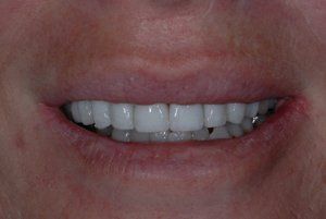 after amalgam removal