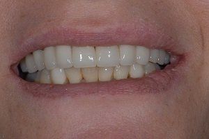 after amalgam removal