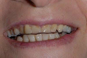 before amalgam removal