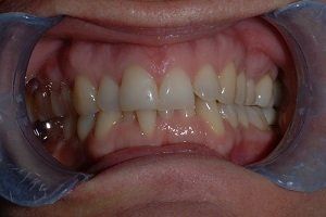 mouth before braces