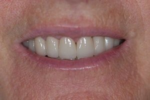 after amalgam removal
