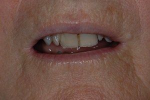 before amalgam removal