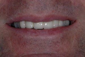 after porcelain veneers