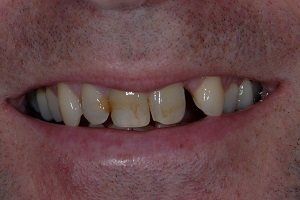 before porcelain veneers