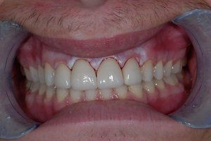 after veneers