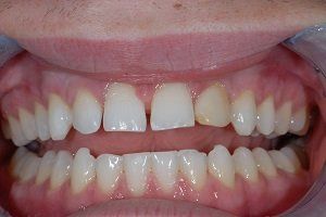 before veneers