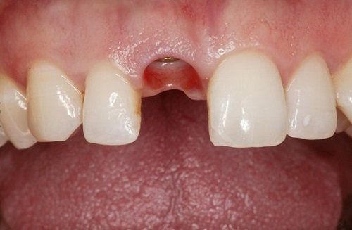 before dental implant