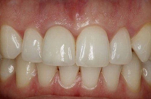 after dental implant