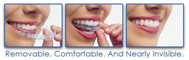 invisalign