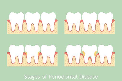 Surgery — Stages Of Periodontal Disease in MILWAUKEE, WI Surgery — Stages Of Periodontal Disease in MILWAUKEE, WI