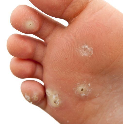 plantar warts craig boulton podiatry plantar warts