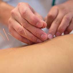 Acupuncture - Acupuncture Treatment in Naples, FL