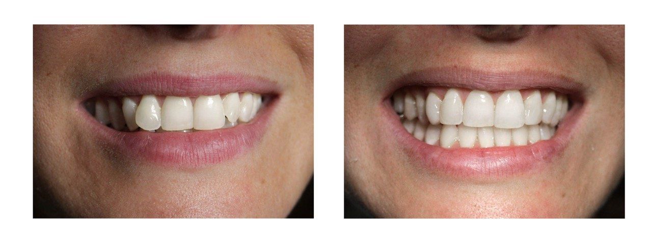 Cosmetic dental treatment before and after image