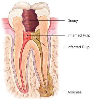 Graphic image of decayed and damaged tooth