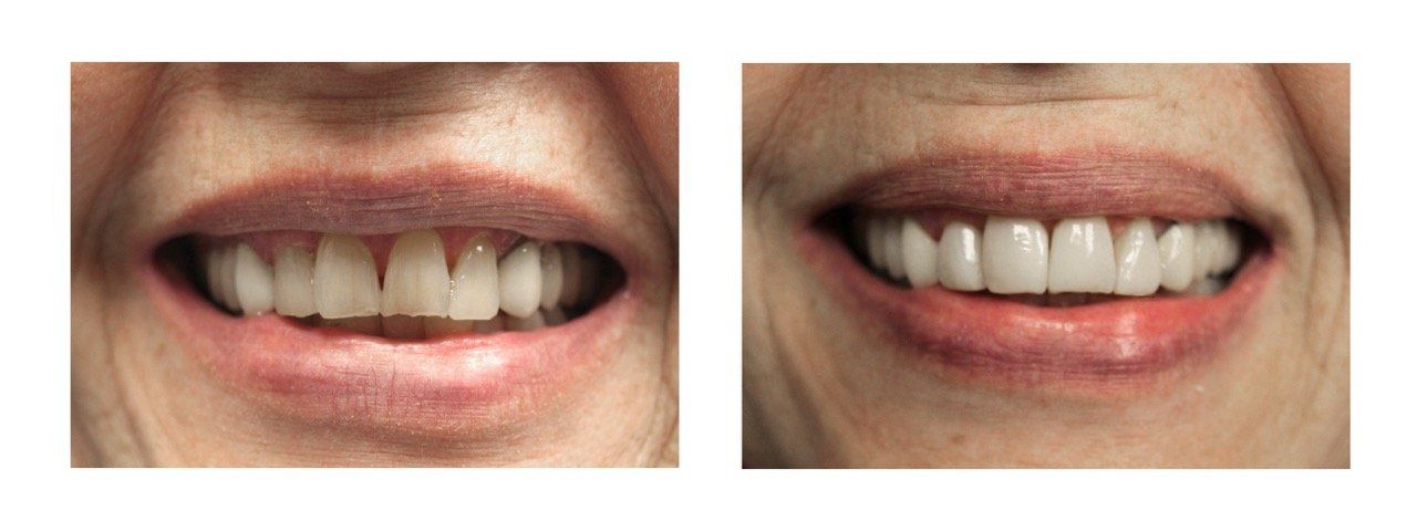 A before and after picture of a woman 's teeth.